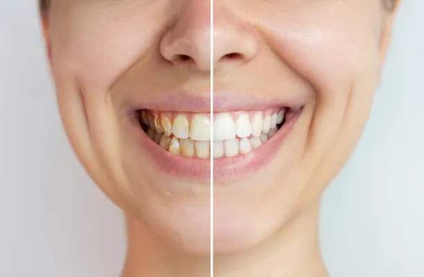 Woman before and after whitening