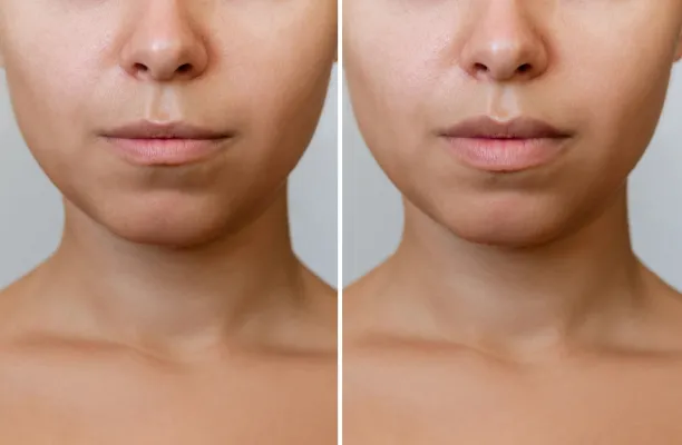 Woman before and after lip fillers
