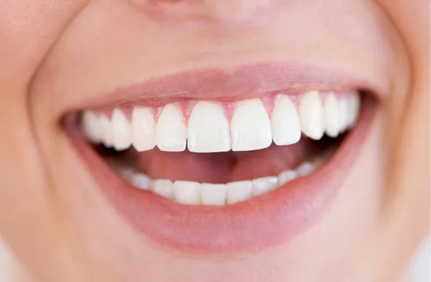 Woman with veneers